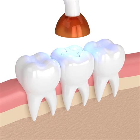 Tooth-Colored Fillings - NKC Dental