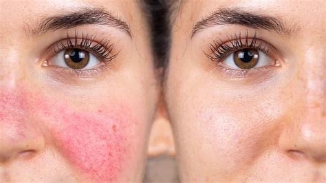 The Challenge With Treating Rosacea Bondi Junction Cosmetic Clinic