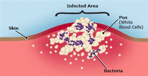 Infected Wounds - Helping Wounds Heal | Wound Care Specialist NYC ...