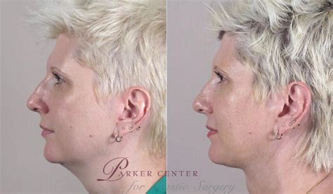 Neck Contouring Before And After Pictures Case 226 Paramus New Jersey Parker Center For