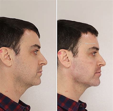 Jaw Enhancement With Dermal Fillers In Vancouver One Clinic Md