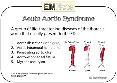 Aortic Dissection Signs And Symptoms