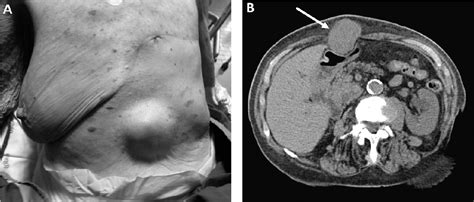 Figure 1 From An Unusual Subcutaneous Breast Cancer Metastasis In A 86