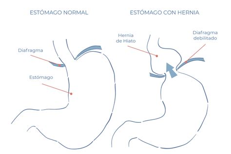 Hernia De Hiato Causas Y Tratamiento Hospitales