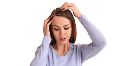 Hair Transplant For Women Imed Medical