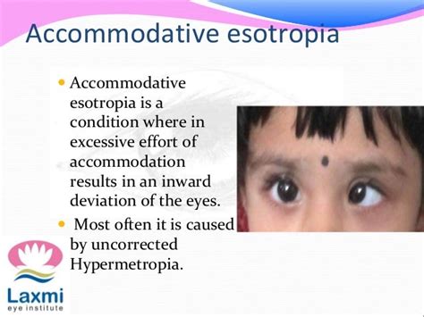 Accommodative esotropia