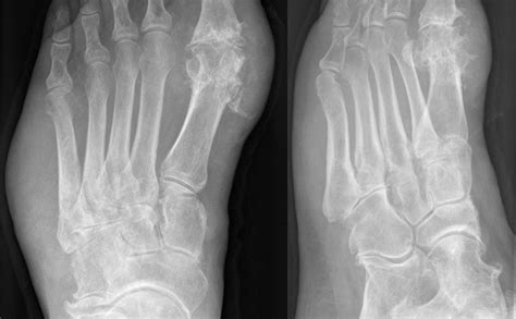 Toe Fracture Treatment Toe Bone Fracture Surgery