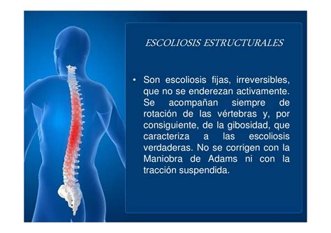 Escoliosis Expo Final Ortopedia