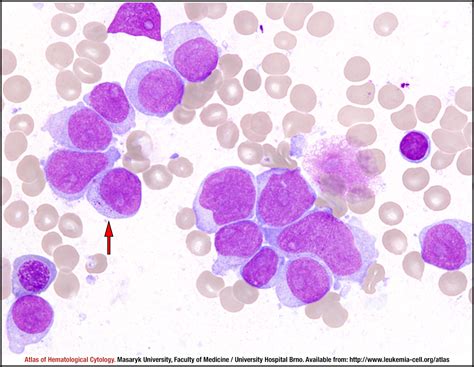 Acute Myelomonocytic Leukemia