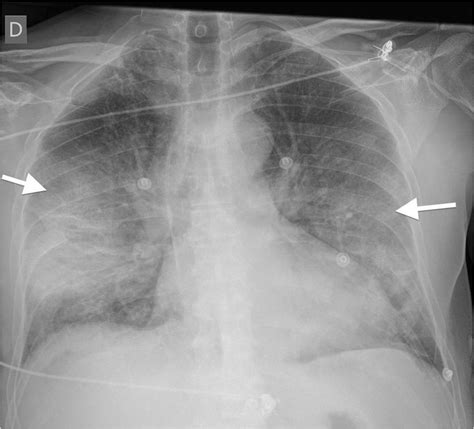 Chest radiograph image from a confirmed COVID-19 case demonstrating ...