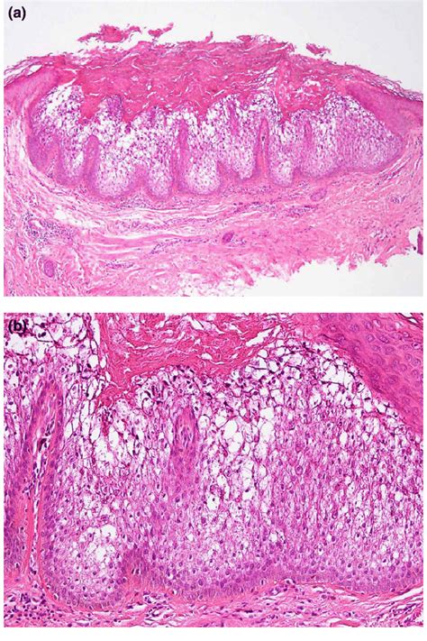 Histopathology Of Epidermolytic Acanthoma This Is A Well Demarcated