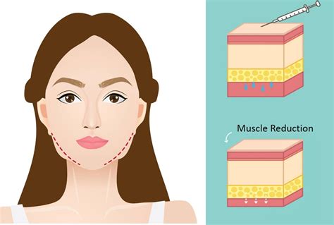 V Shape Facial Contouring In Singapore Everything You Need To Know