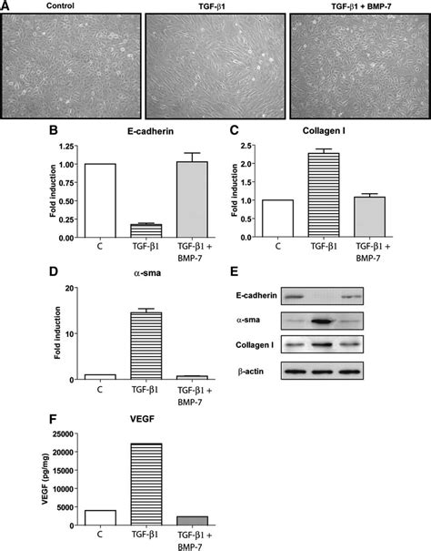 BMP 7 blocks TGF β1 induced EMT of MC Omentum derived MC were treated