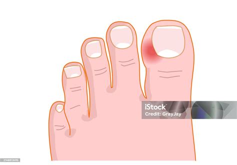 Paronychia Is An Infection Of The Proximal And Lateral Toenail And ...