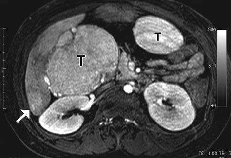 Pediatric Liver Masses Radiologic Pathologic Correlation Part 1