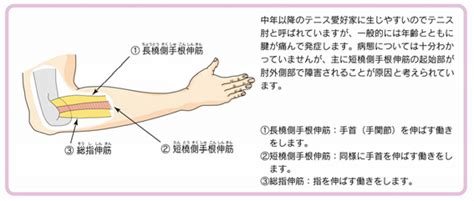 テニス肘 聖マリアンナ医科大学 横浜市西部病院