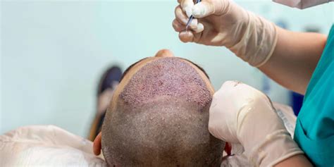 Best Hair Transplant Results Asli Tarcan Clinic