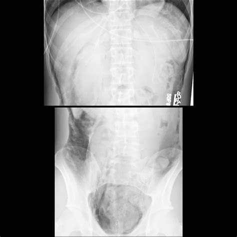 Pediatric Pneumoretroperitoneum Pediatric Radiology Reference Article