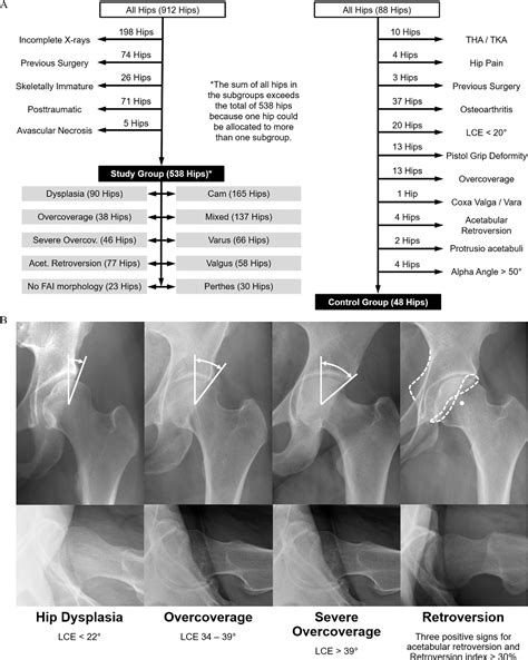 Figure 1 From Diagnosis Of Acetabular Retroversion Three Signs