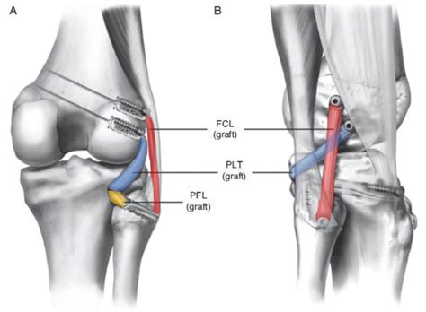 Posterior Lateral Knee Pain