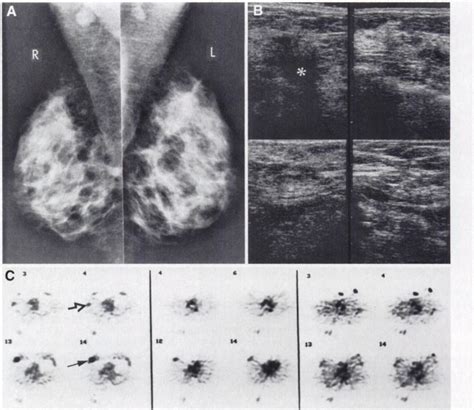 Right Breast Cancer And Axil Lary Metastasis A Mammogram Shows A Download Scientific Diagram