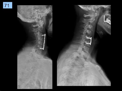 1 Cervical Spine Rtec 124 Week 6 Rev