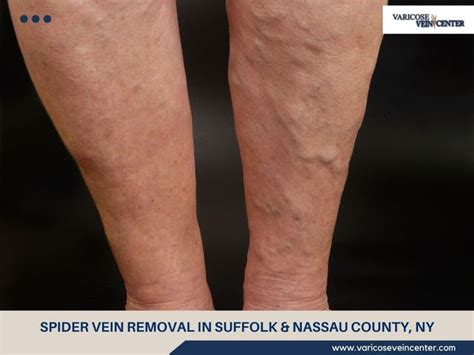 Vein Doctor — Port Jefferson Ny Port Jefferson Ny Patch