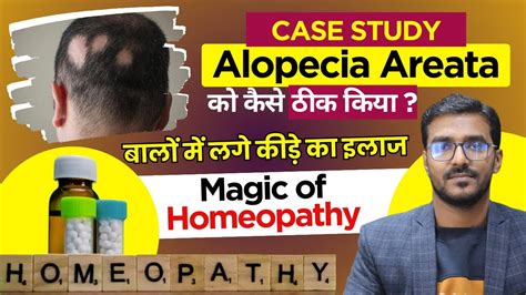 Alopecia Areata Patchy Hair Loss Treatment Jad Se Gayab Bal Dobara Ugaye 100 Garanty K Sath