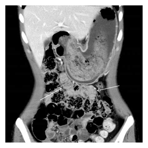 Trichobezoar In The Gastrointestinal Tract Causing High Level