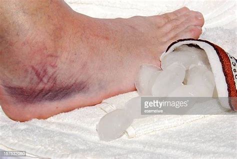 16 Ice Sprained Ankle Stock Photos, High-Res Pictures, and Images ...