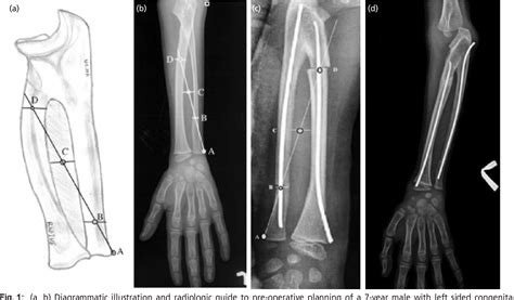 Figure 1 From Improving The Accuracy Of Corrective Osteotomy For