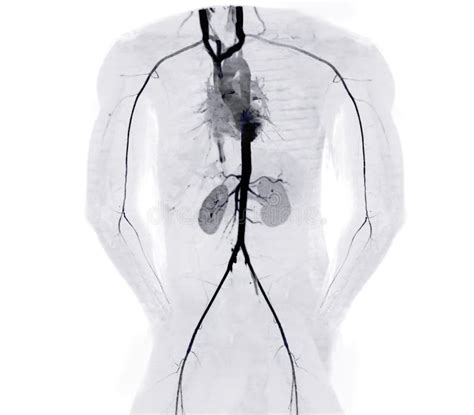 Cta Brachial Artery Or Ct Scan Of Upper Extremity 3d Rendering Image