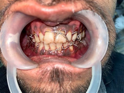 Intermaxillary Fixation For Lower Jaw Mandibular Fracture North The