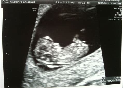 Athena's Chateau: 1st Nuchal Translucency Ultrasound, 4/18/2011