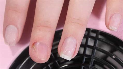 Fingernail Fungus from Acrylic Nails: Causes, Treatment, More – My ...