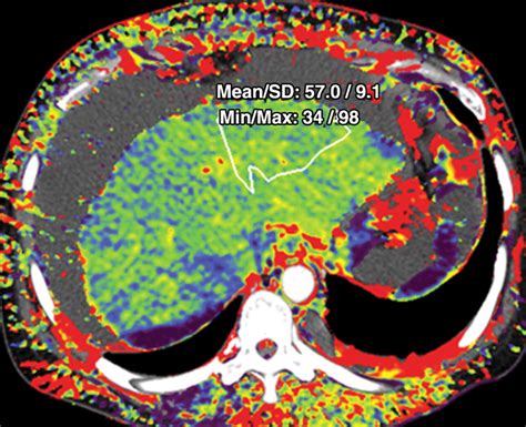 Quantitative Color Mapping Of The Arterial Enhancement Fraction In