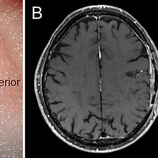 Intraoperative photograph taken after opening the arachnoid membrane ...