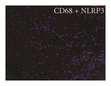 Mrna And Protein Expression Of Nlrp3 Caspase1 And Il 1β In Diabetic