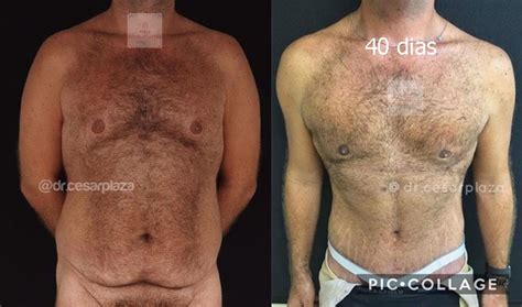 Cirurgia Ginecomastia Antes E Depois Quotes Trendy