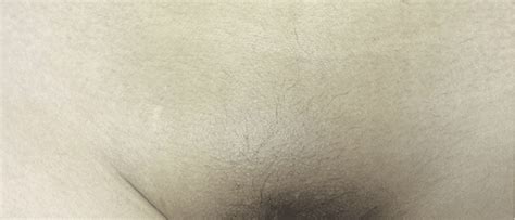 Hình ảnh kết quả trước và sau khi triệt lông bikini Spa Làm đẹp Thẩm mỹ Sen