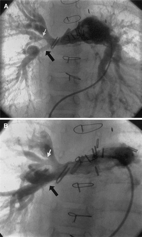 Pulmonary Arteriograms Before A And After B Balloon Dilatation Of