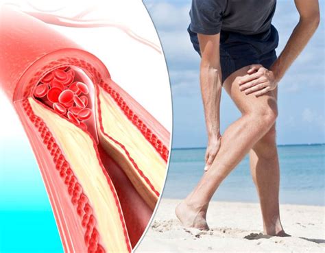 Infection In The Legs May Be Peripheral Artery Disease Peripheral