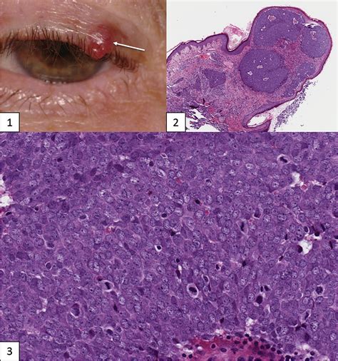 Merkel Cell Carcinoma Of The Eyelid Ophthalmology