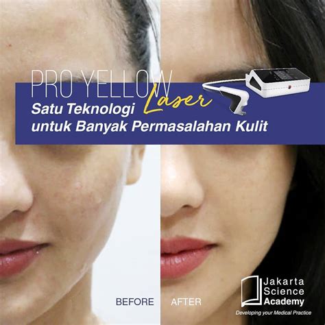ketahui   pro yellow laser  manfaatnya jakarta science academy