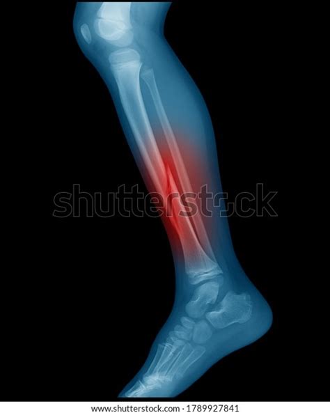 4 445 Tibia Fracture Bilder Stockfotos Und Vektorgrafiken Shutterstock