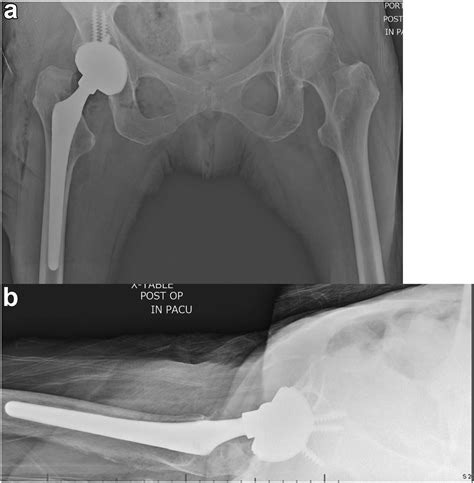 Intraprosthetic Dislocation Of A Modular Dual Mobility Total Hip