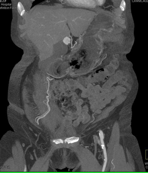 Vascular Metastases To Muscle From Renal Cell Carcinoma