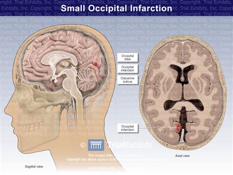 Small Occipital Infarction Trialquest Inc