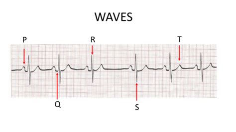 12 Lead EKG Exam Flashcards | Quizlet