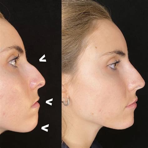 Liquid Nose Liquid Rhinoplasty Modern Plastic Surgery Miami